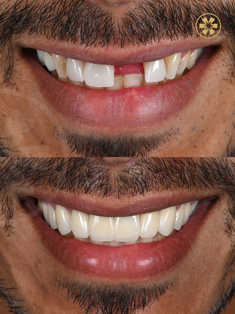 صورة قبل وبعد لابتسامة مريض في مركز كرييتف آرتس بدبي