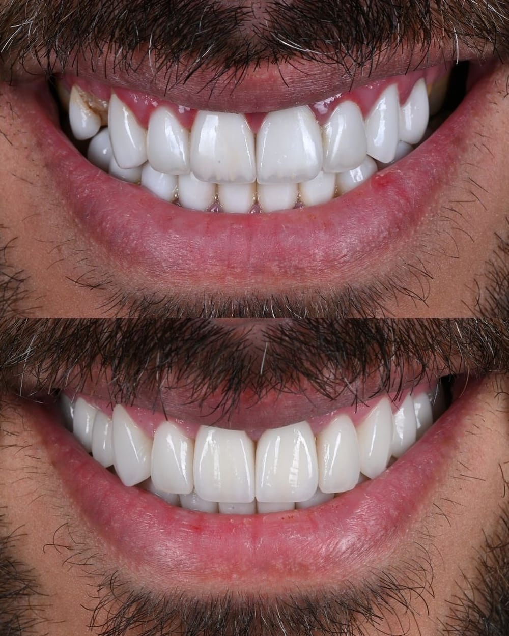 صورة قبل وبعد لابتسامة مريض في مركز كرييتف آرتس بدبي