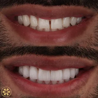 صورة قبل وبعد 1 لحالة Daneal — تجميل الابتسامة في دبي