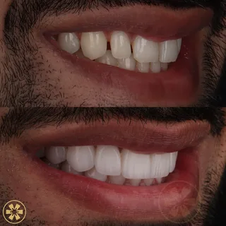 صورة قبل وبعد 2 لحالة Daneal — تجميل الابتسامة في دبي