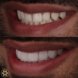 صورة قبل وبعد 3 لحالة Daneal — تجميل الابتسامة في دبي