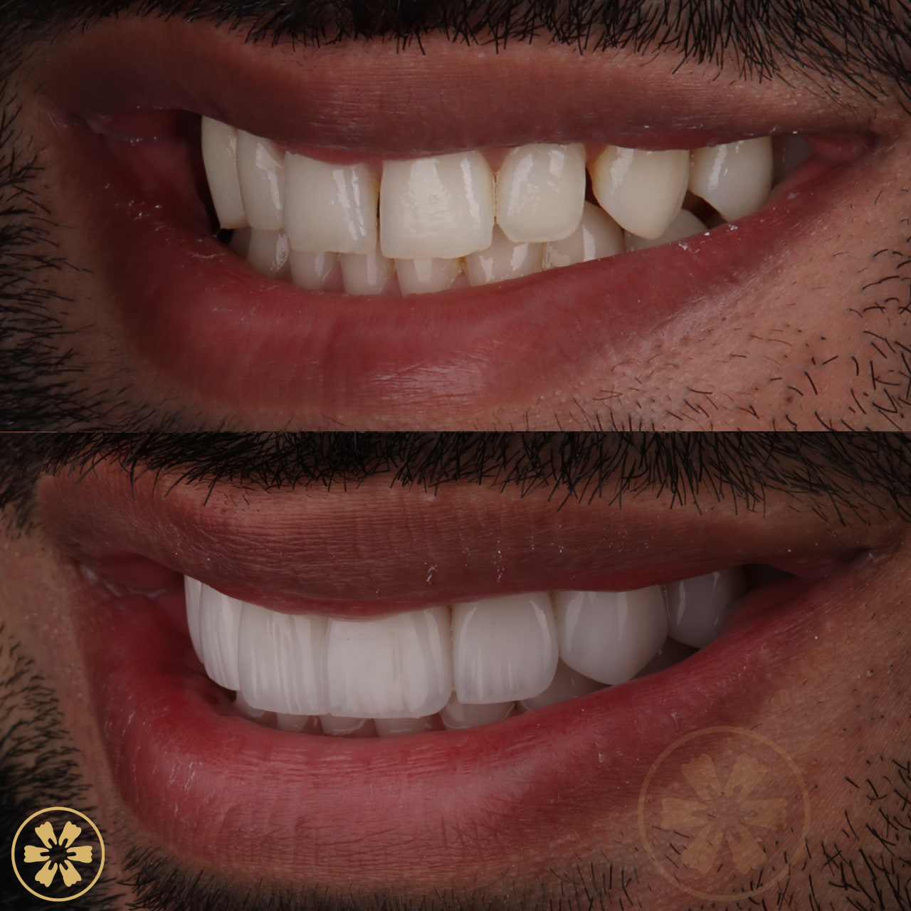 دانيال قبل وبعد تجميل الابتسامة: فراغ بين السنّين الأماميتين وحواف غير متساوية، ثم ابتسامة بيضاء متصلة (2)