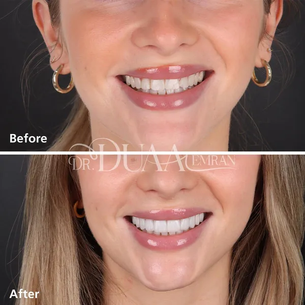 Before and after veneers by Dr. Duaa Emran, front view