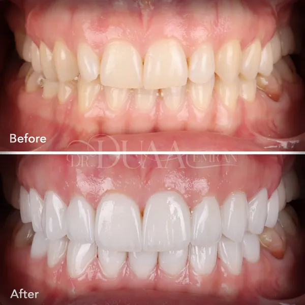 Hollywood smile before and after, upper and lower veneers, Dr. Duaa Emran