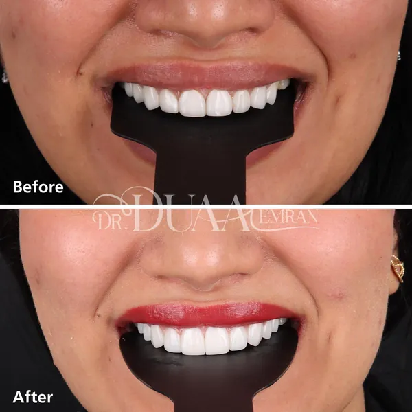 Smile redesign with new veneers, before and after, Dr. Duaa Emran