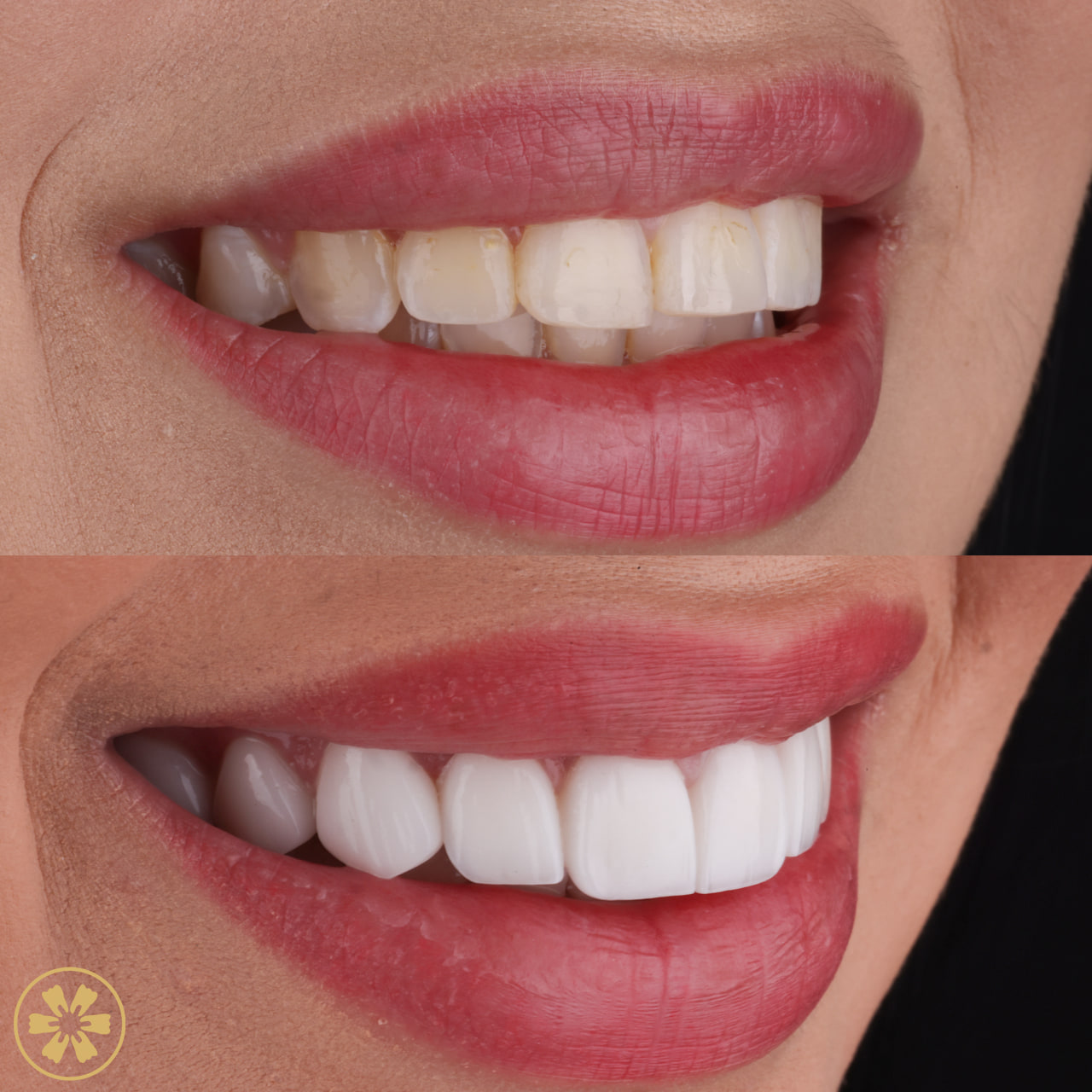 Nataly before and after her Hollywood smile: upper teeth in mixed shades with a darker tooth, then an even white row (1)