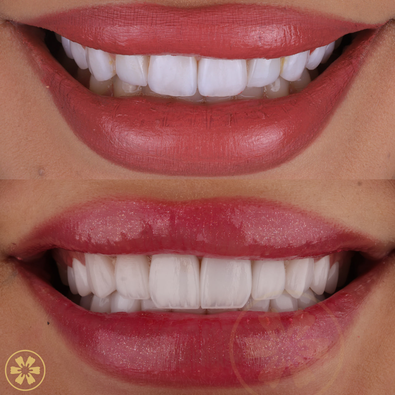 Parshang before and after full smile rehabilitation: short upper teeth and darker lower teeth, then longer teeth in one white shade