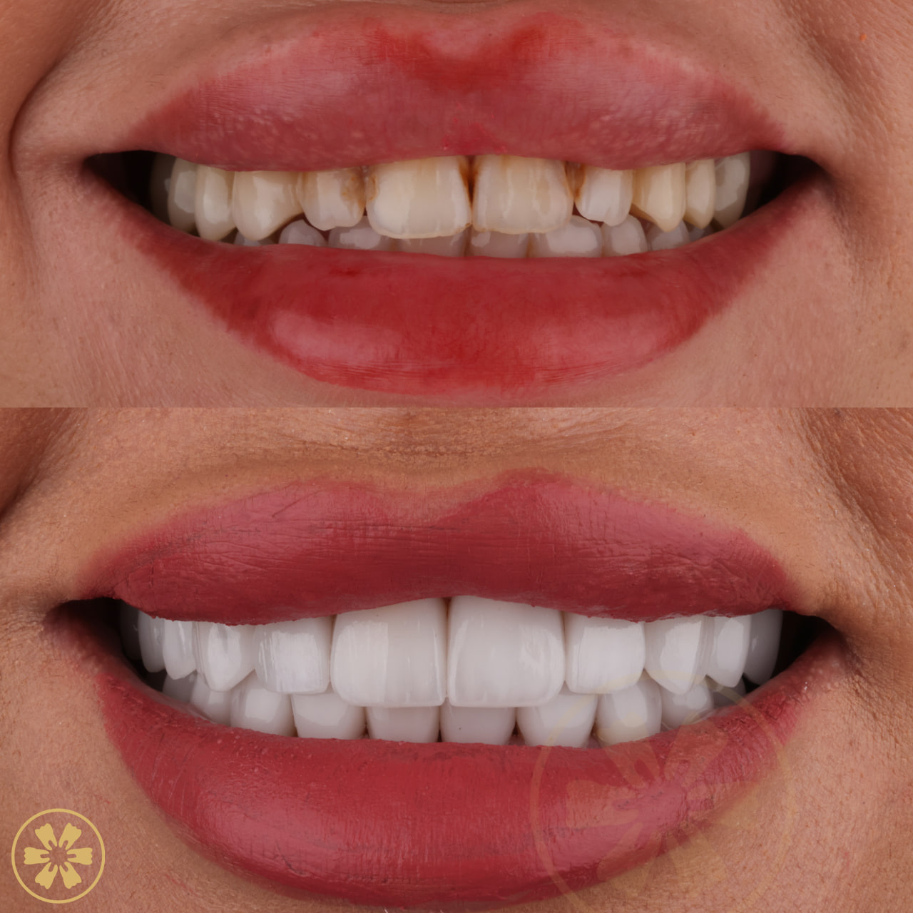 Shahed before and after porcelain veneers: brown stain between the front teeth and chipped edges, then an even white smile