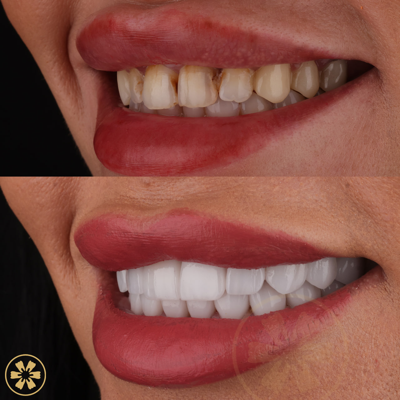 Shahed before and after porcelain veneers: brown stain between the front teeth and chipped edges, then an even white smile (1)