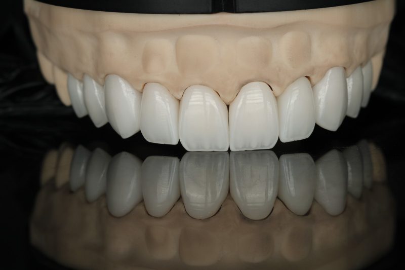 Finished upper anterior arch photographed frontally on a working model