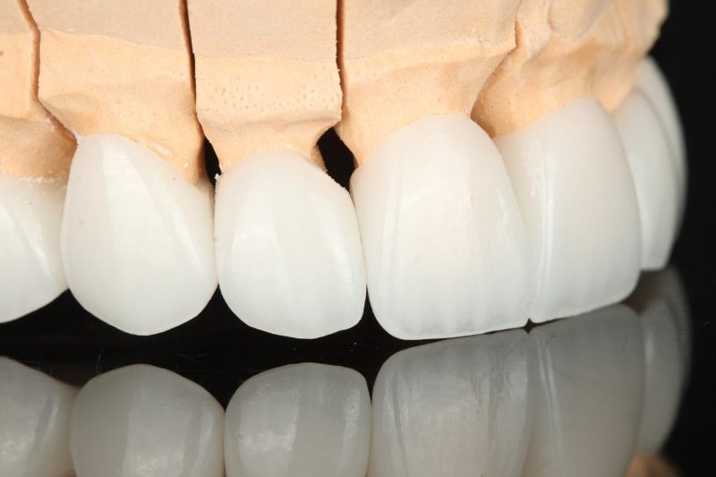 Ceramic front-tooth crowns seated on a sectioned die model in the laboratory