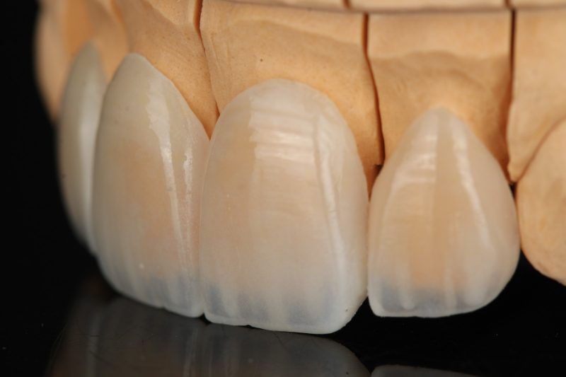 Close view of the front surface of upper anterior units showing surface texture and shade gradient