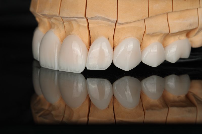 Upper anterior units seated on a sectioned stone model, frontal view