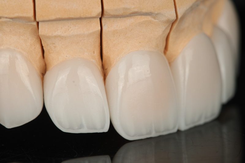 Side view of anterior units on a working model showing how they emerge from the gum line
