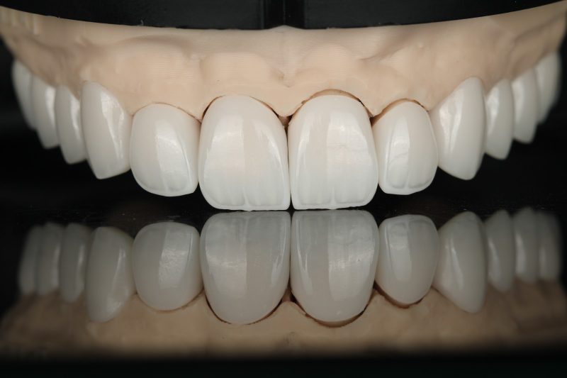 Upper and lower ceramic work in occlusion on models at our Dubai laboratory