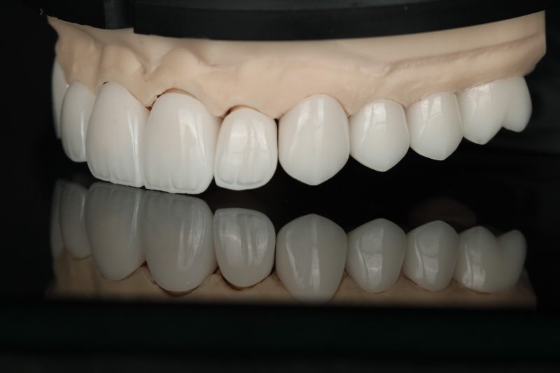 Upper ceramic arch on a working model, frontal view