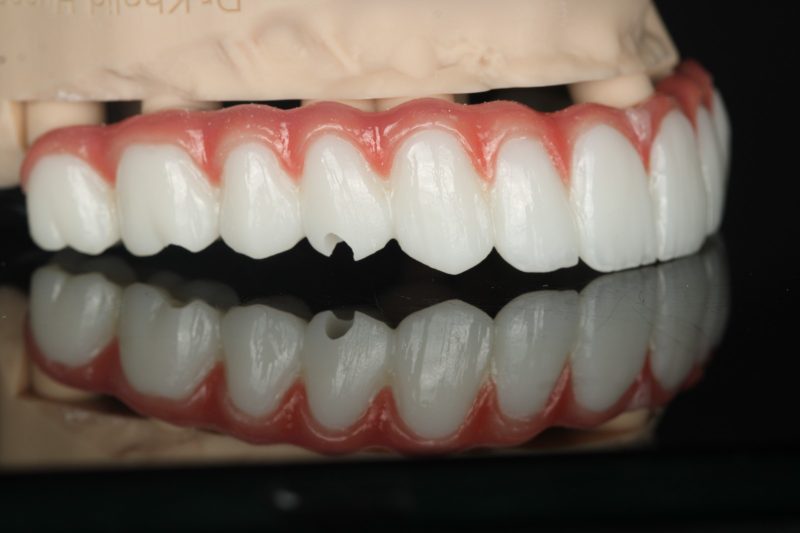 Full-arch prostheses with pink gingival work, upper and lower, on models