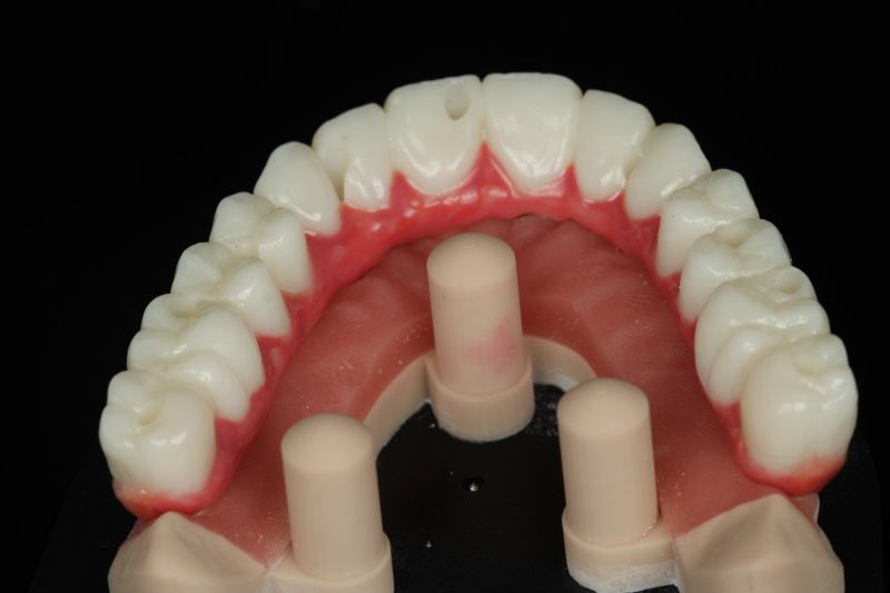 Occlusal view of a full-arch prosthesis with gingival work