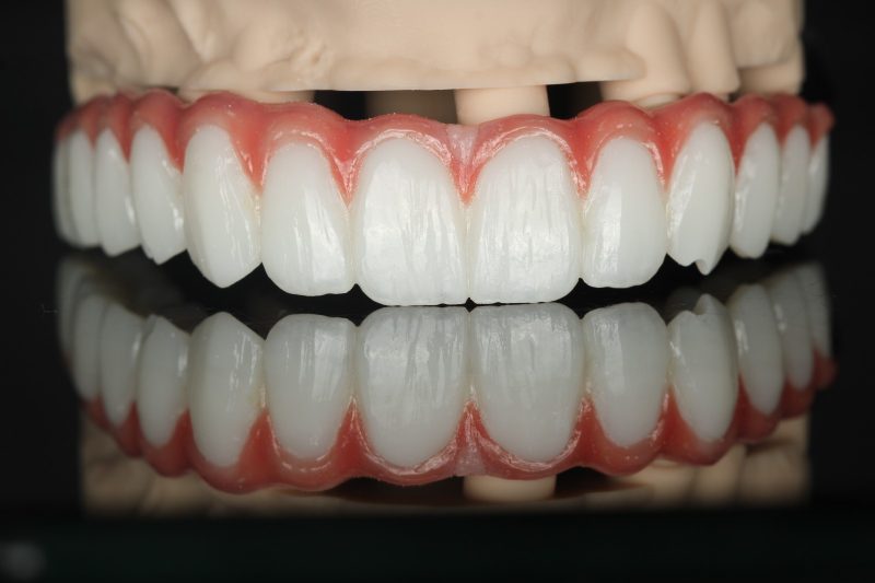 Upper and lower full-arch prostheses in occlusion on articulated models