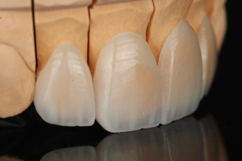 Close view of the biting edges of ceramic front teeth showing translucency, made at Creative Art Dental Lab