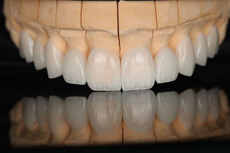 A run of upper anterior units on a working model at our Dubai laboratory