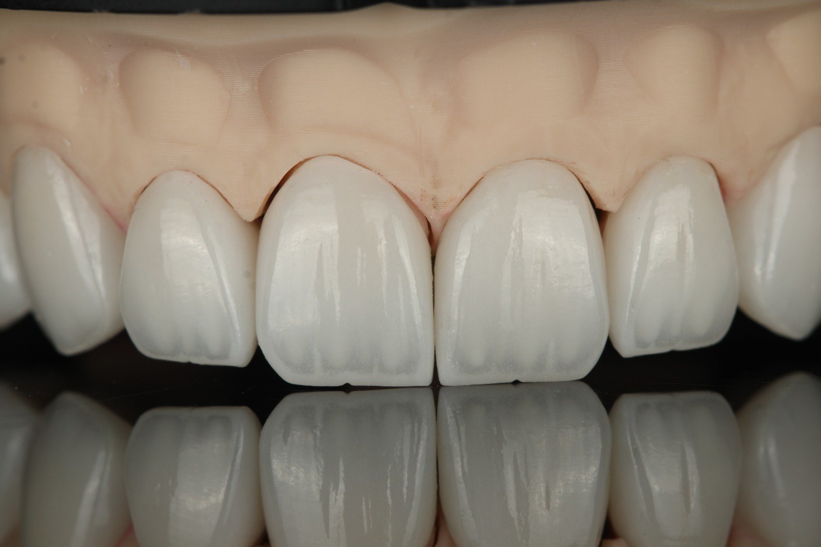 Keramik-Veneers auf dem Arbeitsmodell vor dem Einsetzen — Creative Art Dental Lab, Dubai