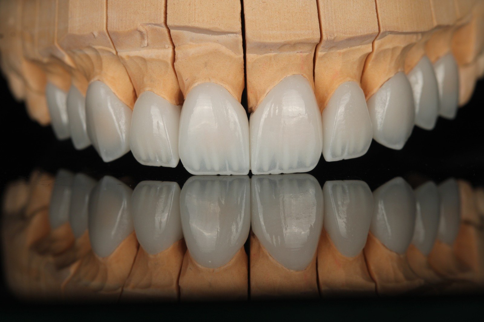 Keramik-Veneers auf dem Arbeitsmodell vor dem Einsetzen — Creative Art Dental Lab, Dubai