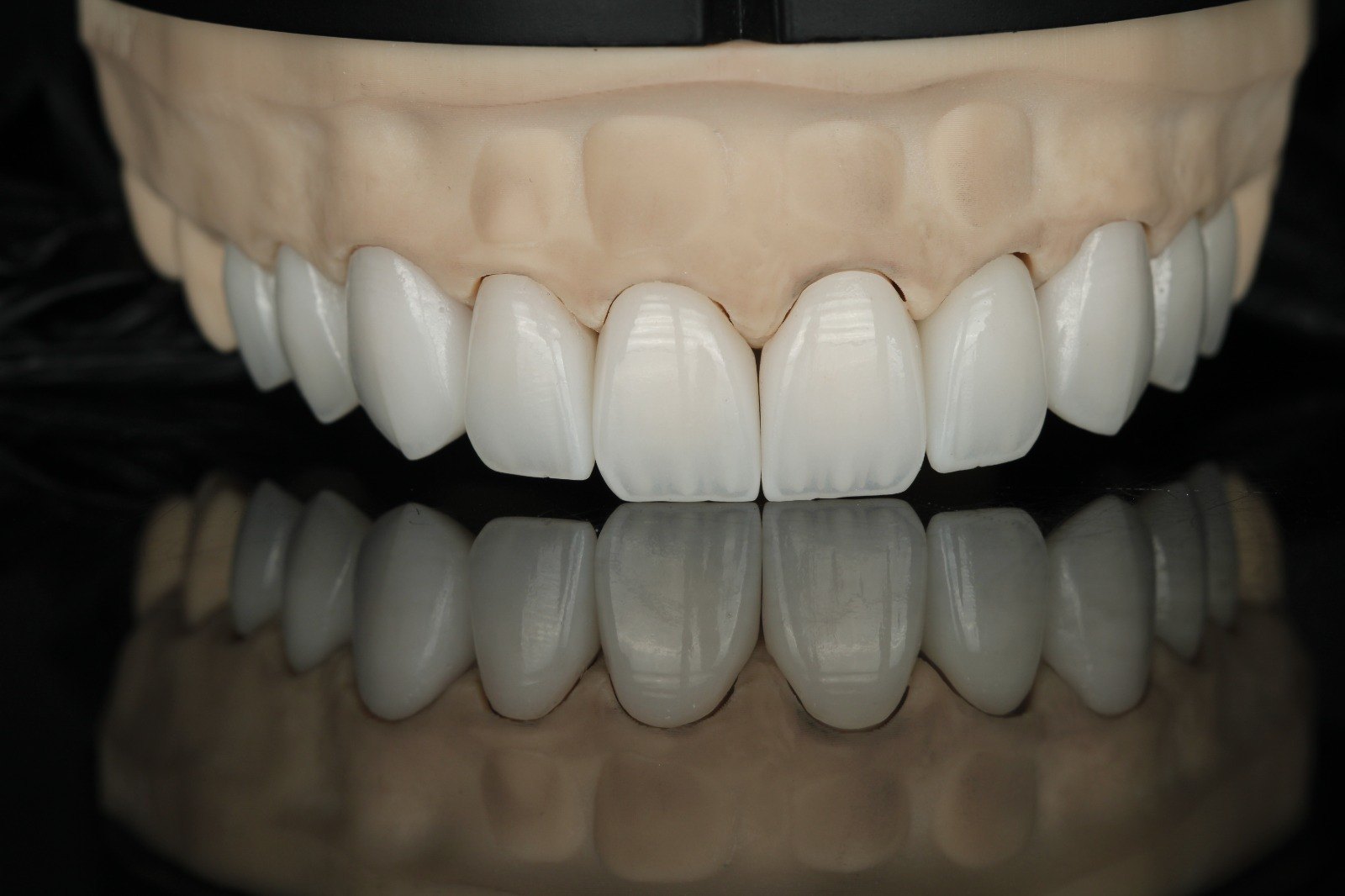 Keramik-Veneers auf dem Arbeitsmodell vor dem Einsetzen — Creative Art Dental Lab, Dubai