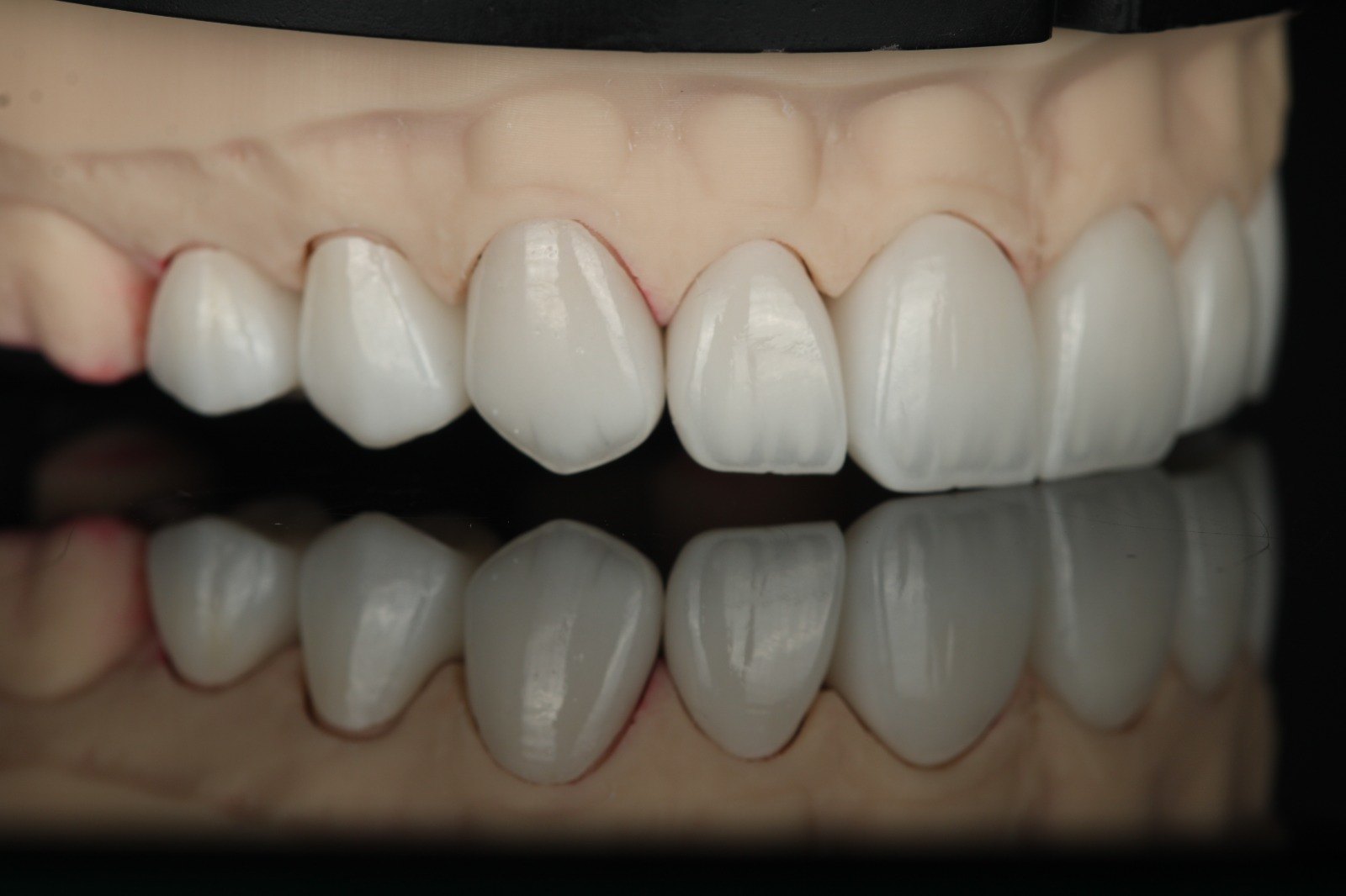Keramik-Veneers auf dem Arbeitsmodell vor dem Einsetzen — Creative Art Dental Lab, Dubai