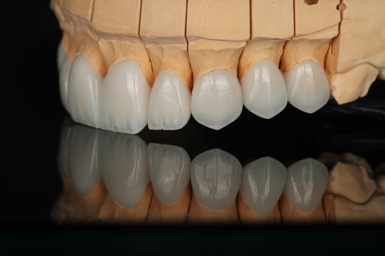 Keramik-Veneers auf dem Arbeitsmodell vor dem Einsetzen — Creative Art Dental Lab, Dubai