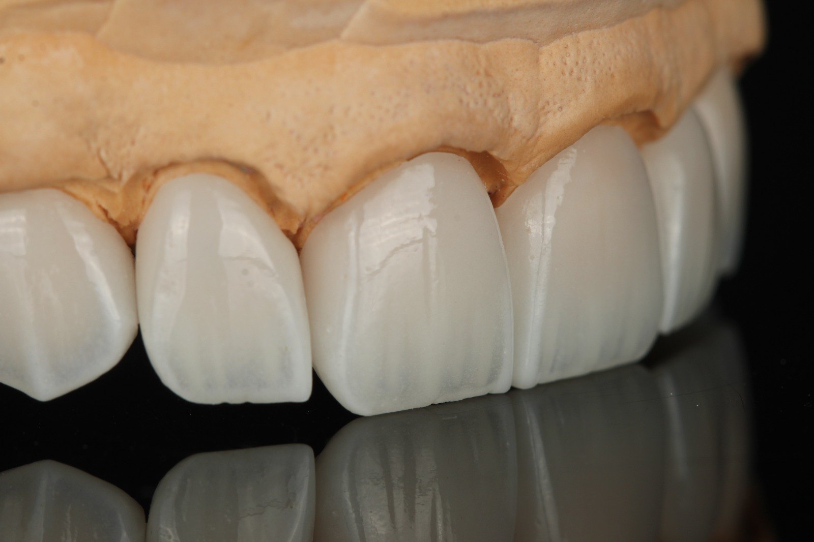 Keramik-Veneers auf dem Arbeitsmodell vor dem Einsetzen — Creative Art Dental Lab, Dubai