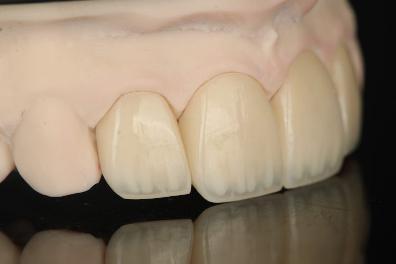 A single anterior unit photographed beside natural-shade neighbouring teeth on a model
