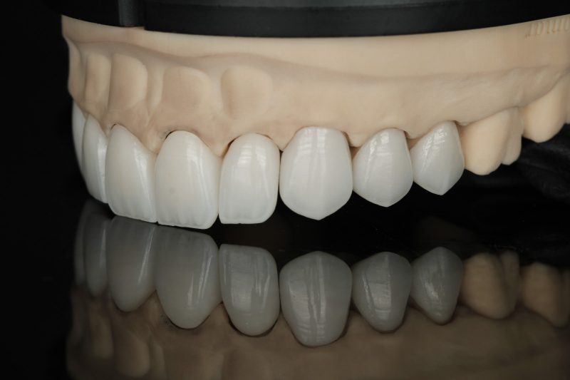 Finished anterior arch photographed in our laboratory