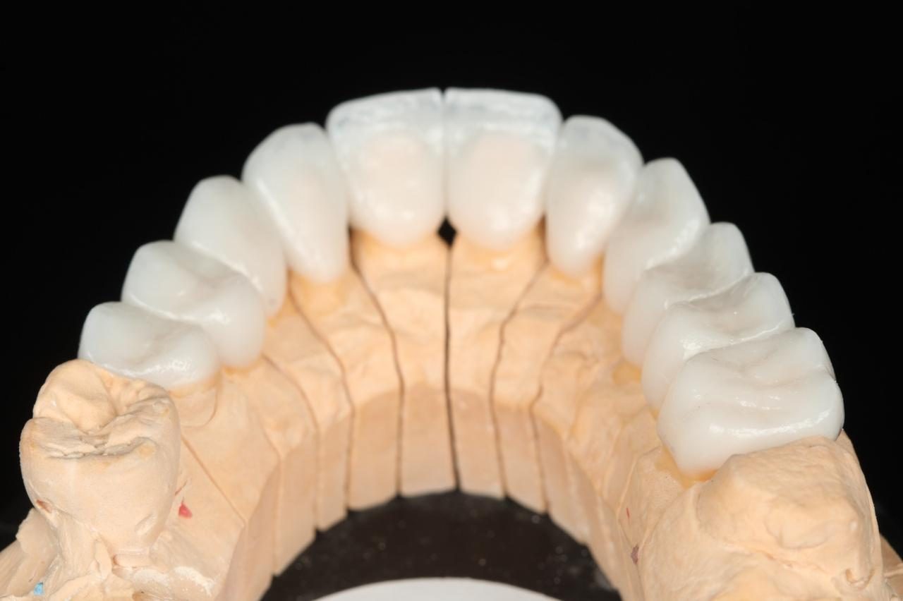 Occlusal view of restorative work on a working model