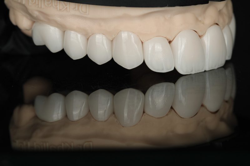 Full-arch ceramic work on a working model in our Dubai laboratory