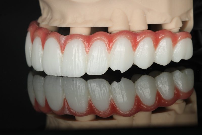 Full-arch prosthesis with gingival work on a model