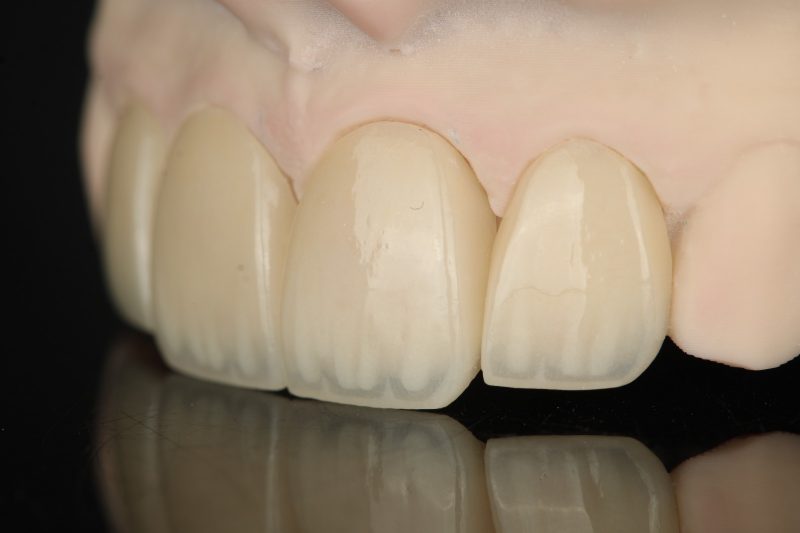 Anterior restorations in a natural shade on a soft-tissue model
