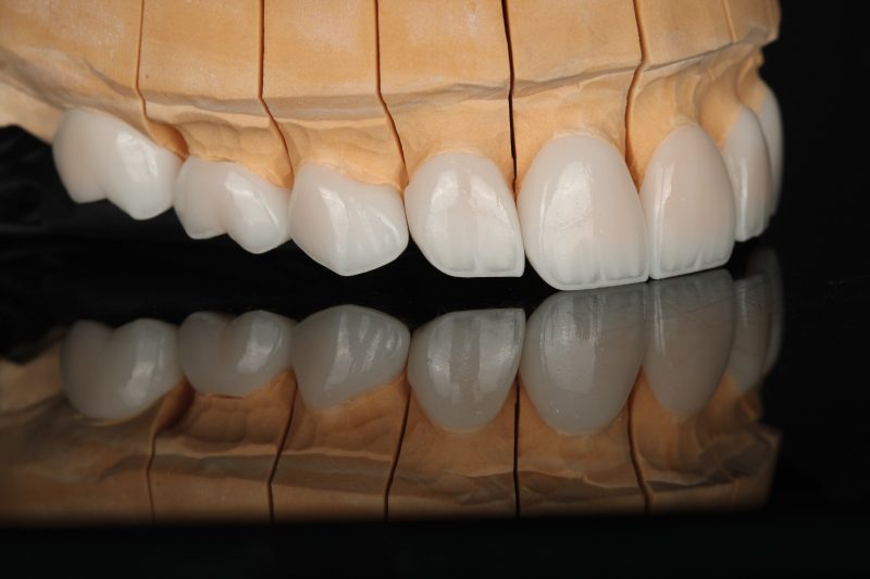 Multi-unit ceramic restorations across an arch on a working model at Creative Art Dental Lab in Dubai