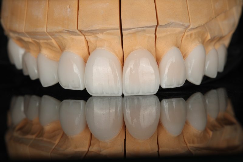 Close view of multi-unit front-tooth restorations on a model in the laboratory