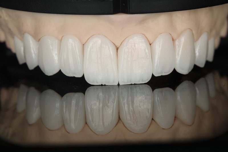 A full upper arch of ceramic units on a working model