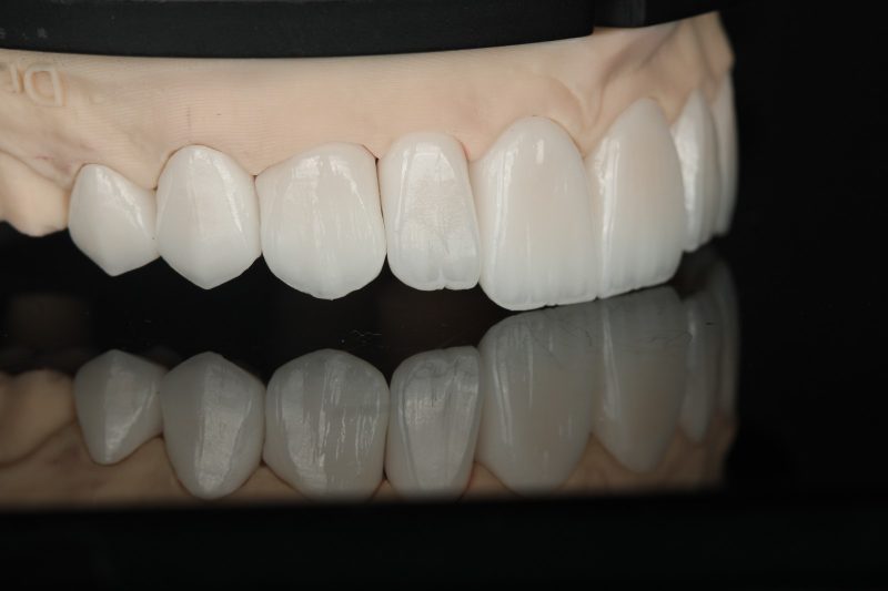 Upper anterior ceramic units on a working model in our Dubai laboratory