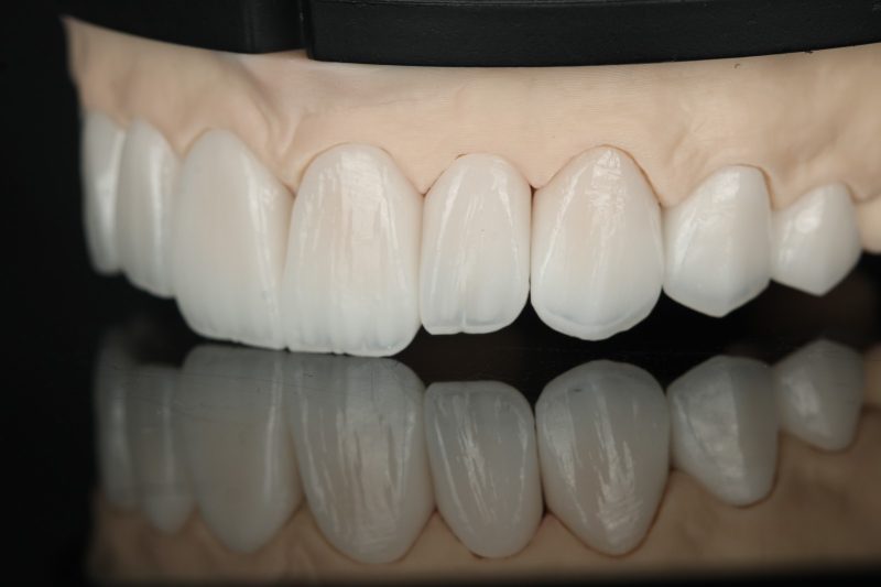 A line of anterior ceramic units assessed together on a model