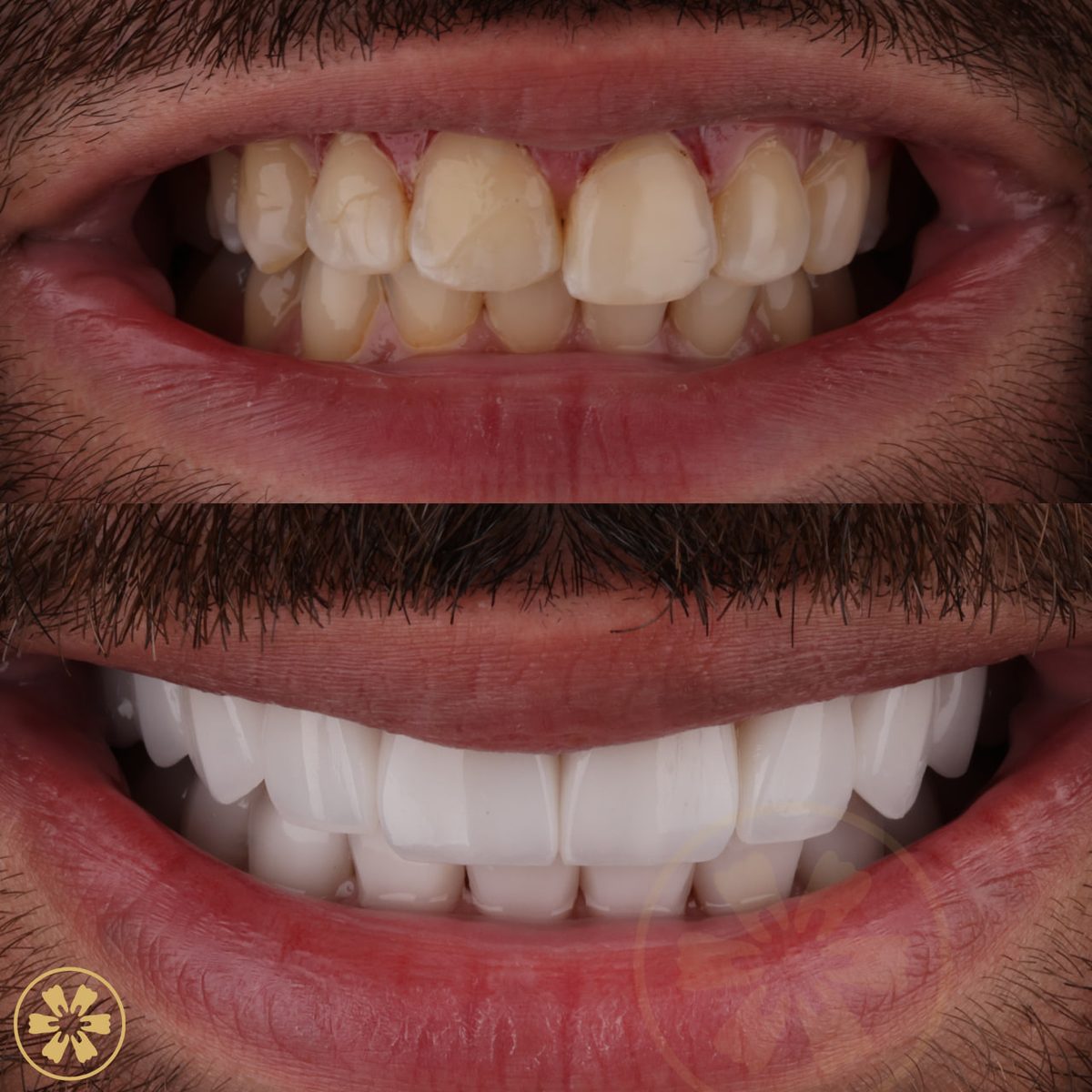 Sorriso con faccette Creative Arts, Dubai