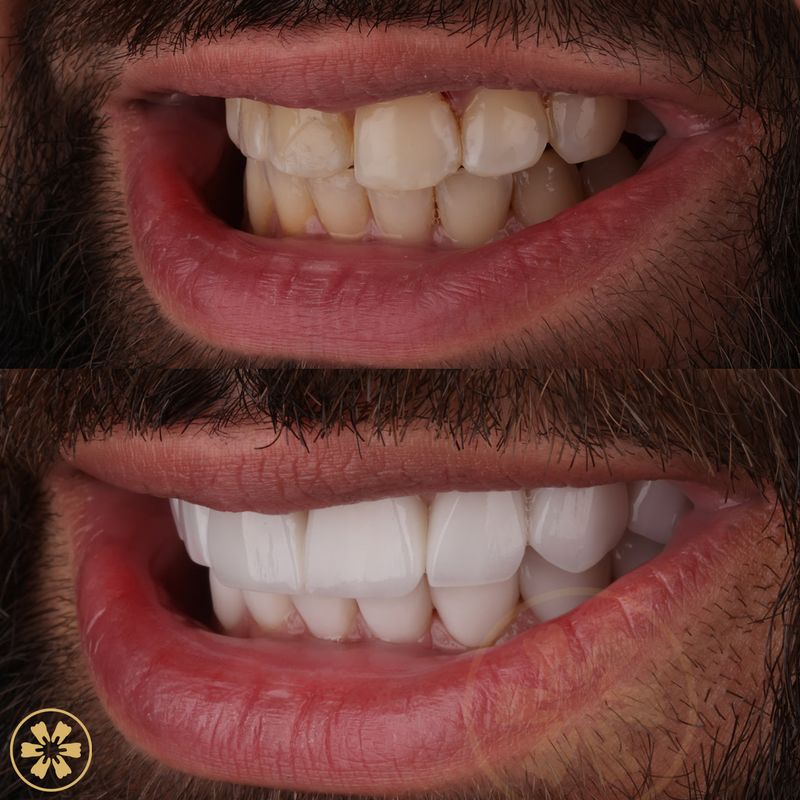 Ahmad's porcelain veneers, before and after (view 3), treated by Dr. Somar Dahdal at Creative Arts Dubai