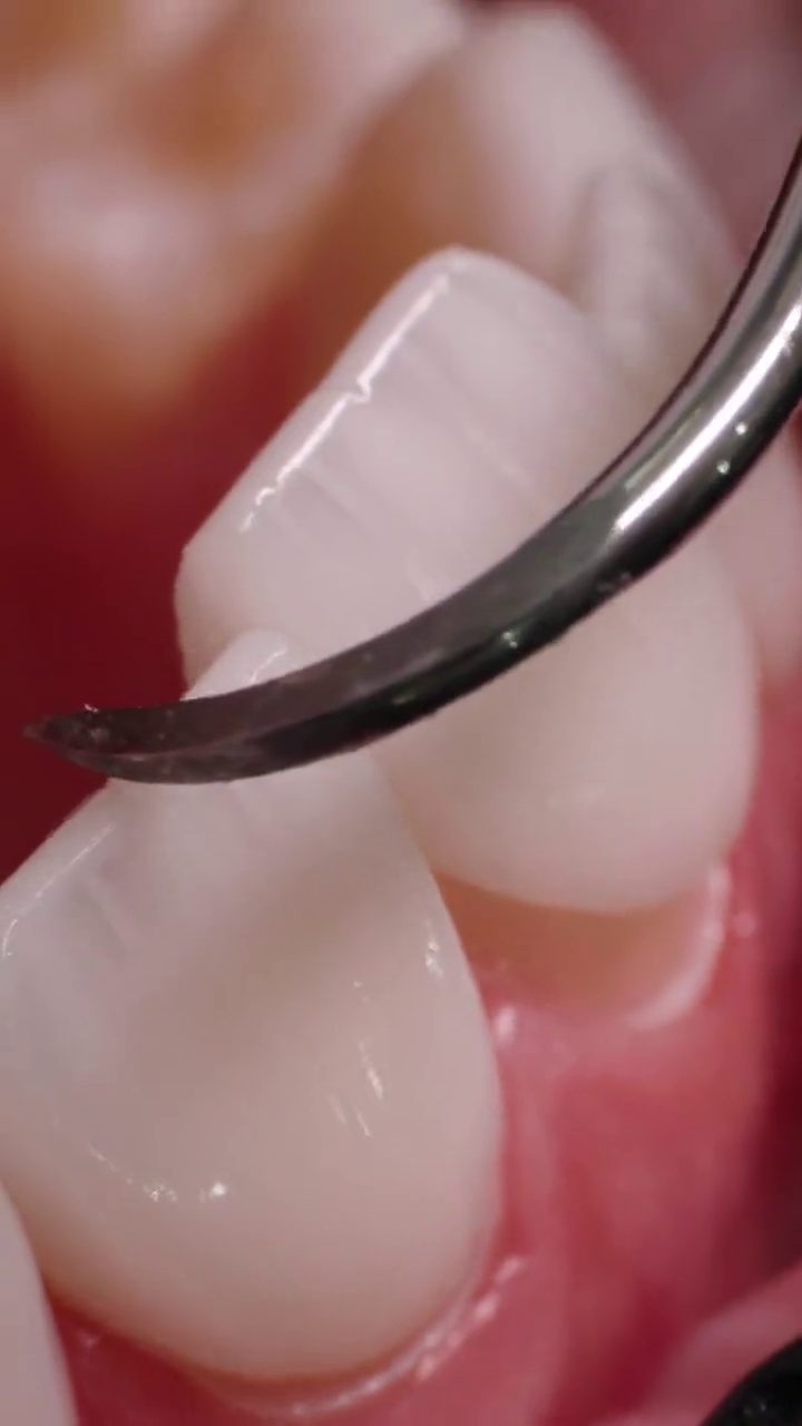 The biting edge of a ceramic veneer checked with a dental instrument during a try-in at Creative Arts Dubai