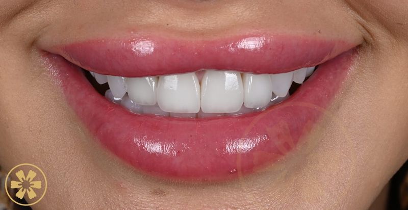 Cynthia's digitally designed porcelain veneers at Creative Arts Dubai