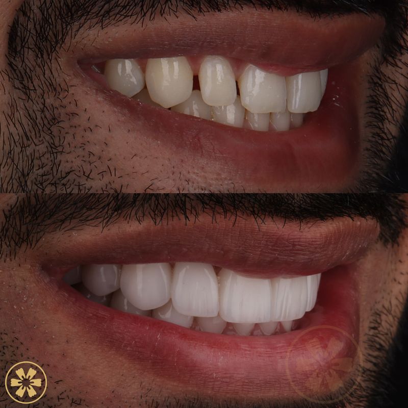 Daneal's smile makeover, before and after (view 2), with Dr. Duaa Ameen at Creative Arts Dubai