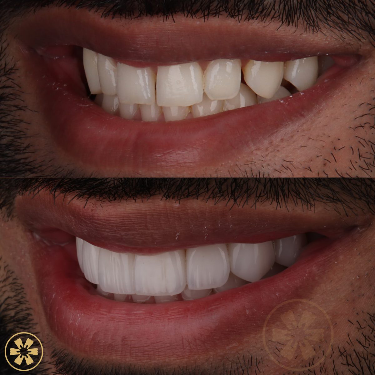 Sorriso con faccette Creative Arts, Dubai