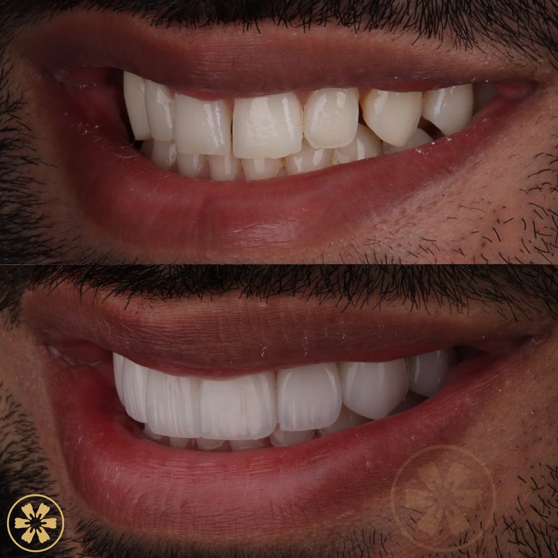 Daneal's smile makeover, before and after (view 3), with Dr. Duaa Emran at Creative Arts Dubai