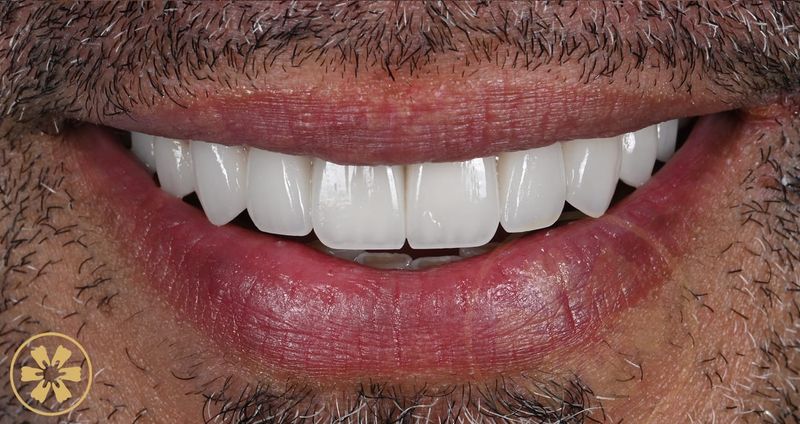 Hesham's digitally designed porcelain veneers at Creative Arts Dubai
